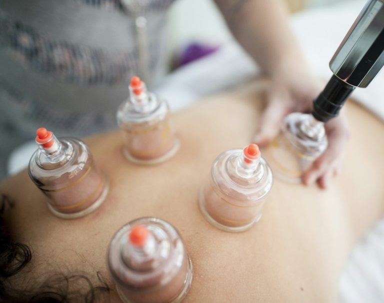 Schröpfen Ich helfe dir zu entspannen und das am besten mit Schröpfen