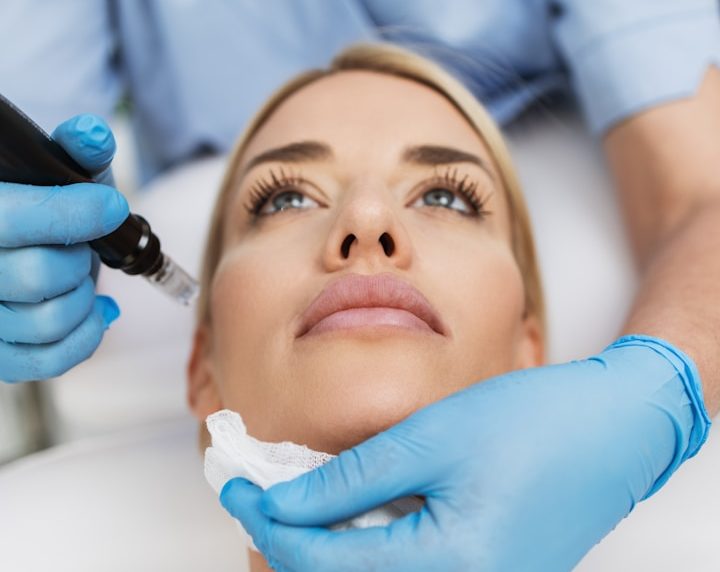 Microneedling Für ein verbessertes Hautbild